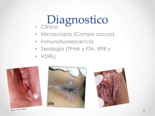 infeccion vaginal sintomas Infeccion vaginal sintomas